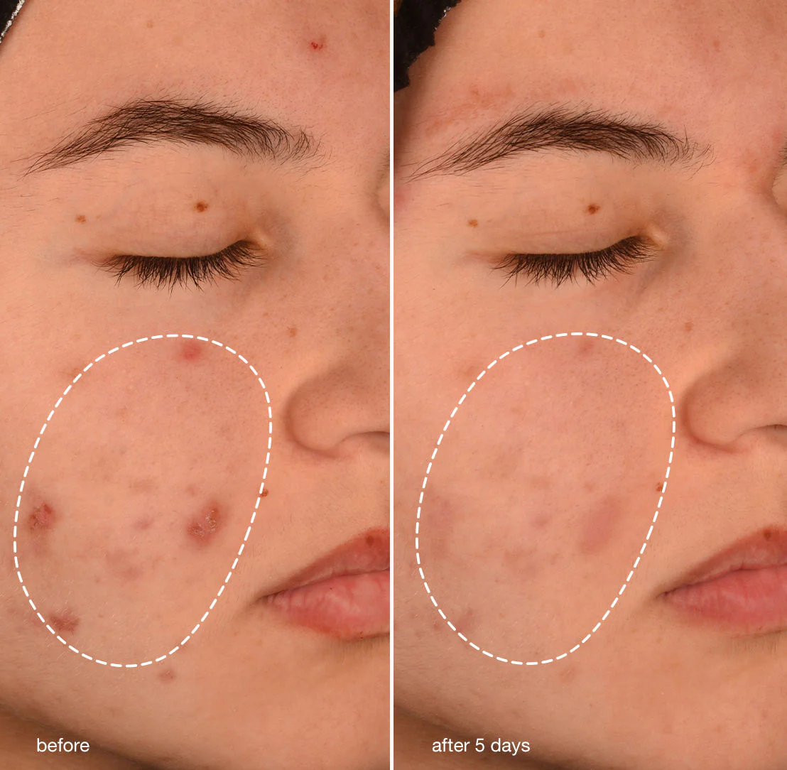 1193-acne-biotic-moisturizer-3.webp Acne Biotic Moisturizer